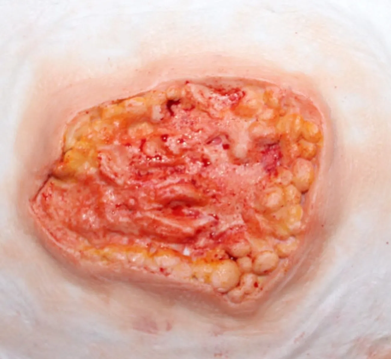 ForensicFX Studios Deep Fatty Tissue Wound Prosthetic> Halloween Accessories