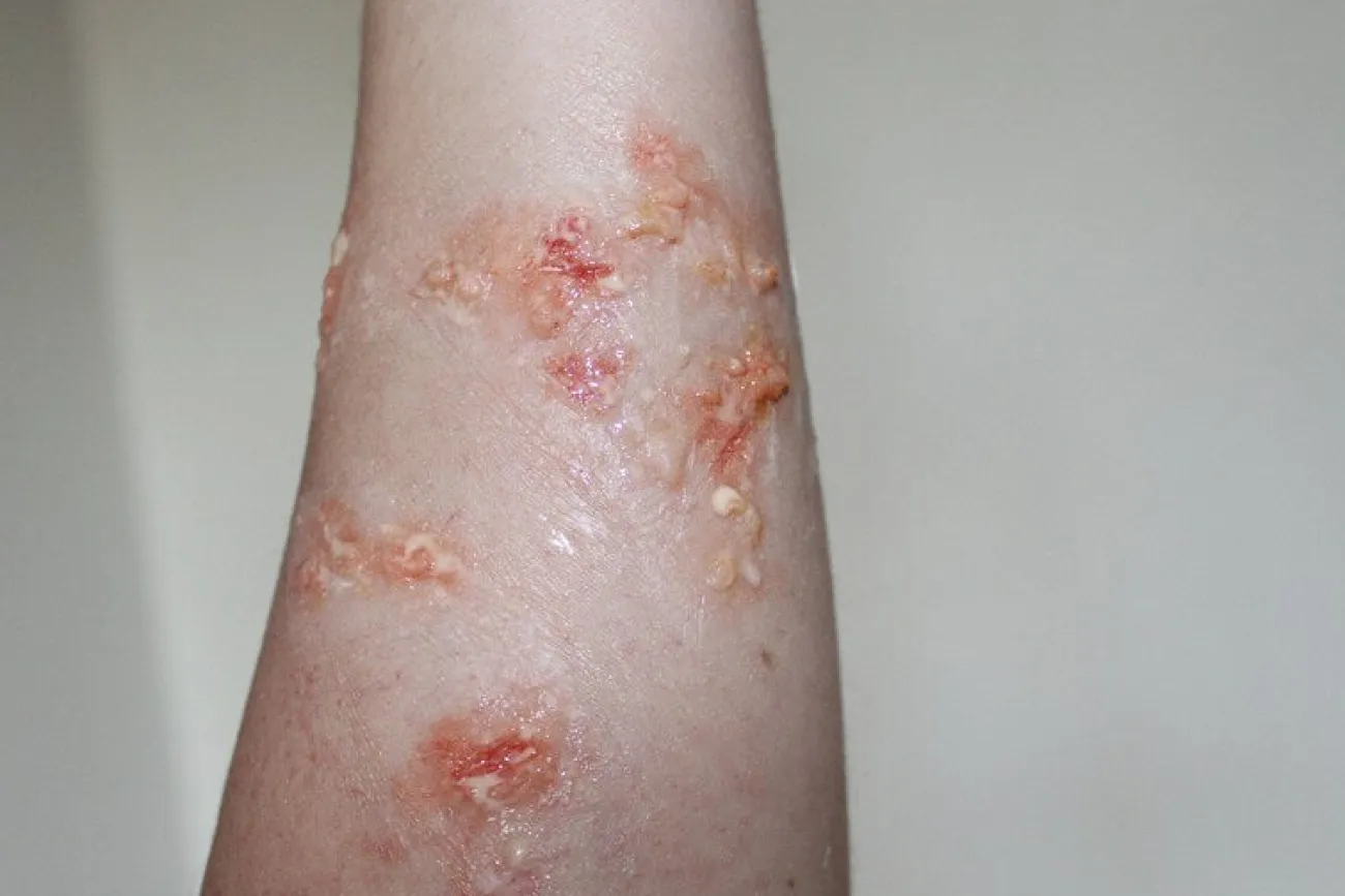 ForensicFX Studios Infected Blisters / Boils Prosthetic> Halloween Accessories