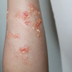 ForensicFX Studios Infected Blisters / Boils Prosthetic><noscript><img width=