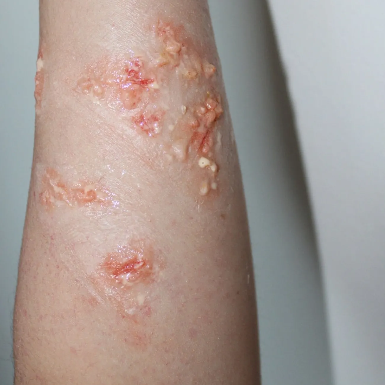 ForensicFX Studios Infected Blisters / Boils Prosthetic> Halloween Accessories