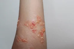 ForensicFX Studios Infected Blisters / Boils Prosthetic><noscript><img width=