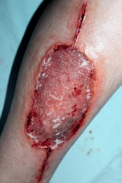 ForensicFX Studios Infected Medical Skin Graft Prosthetic><noscript><img width=