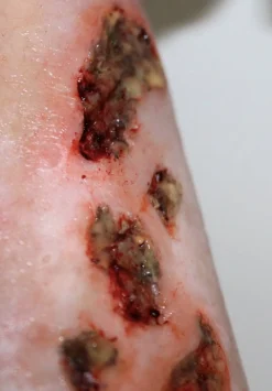 ForensicFX Studios Infected Wound / Burn Prosthetic><noscript><img width=
