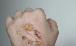 ForensicFX Studios Infected/Burn Wound Prosthetics Bundle></noscript> Halloween Accessories