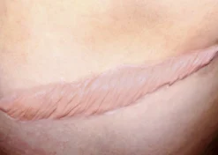 ForensicFX Studios Large Healed Keloid Scar> Halloween Accessories