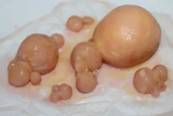 ForensicFX Studios Large Infected Boils Prosthetic><noscript><img width=