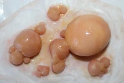 ForensicFX Studios Large Infected Boils Prosthetic><noscript><img width=