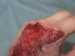 ForensicFX Studios Skin Burn Prosthetic><noscript><img width=