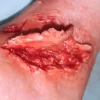 ForensicFX Studios Skin Peeling Back Wound Prosthetic> Halloween Accessories
