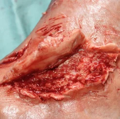 ForensicFX Studios Skin Peeling Back Wound Prosthetic><noscript><img width=
